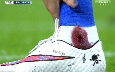 خونریزی پای نیمار در بازی با آتلتیکومادرید